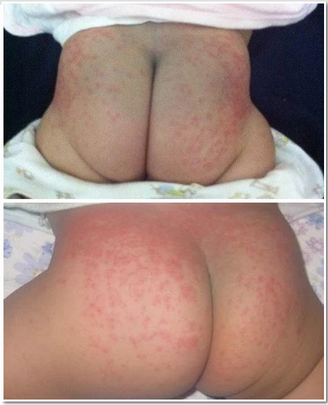 news-Using Diaper is the main cause of baby red ass-JiaQingShuang-img